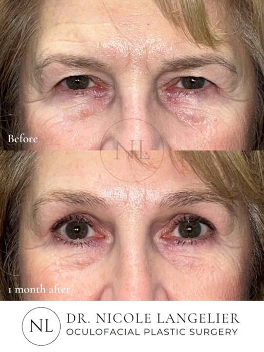 Before and 1 month After Brow Lift