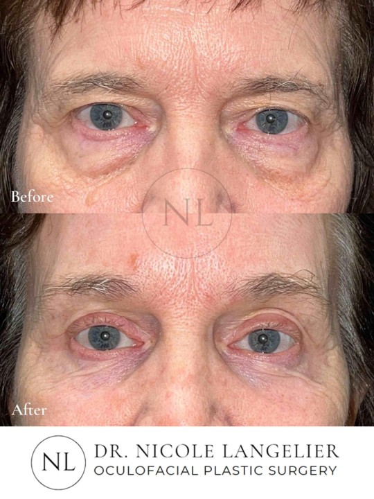 Before and After Brow Lift