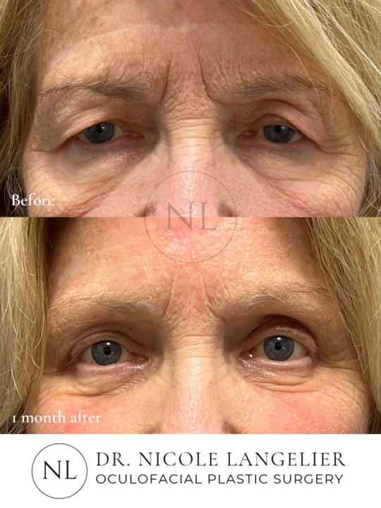 Before and 1 month After Brow Lift