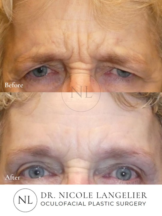 Before and After Brow Lift