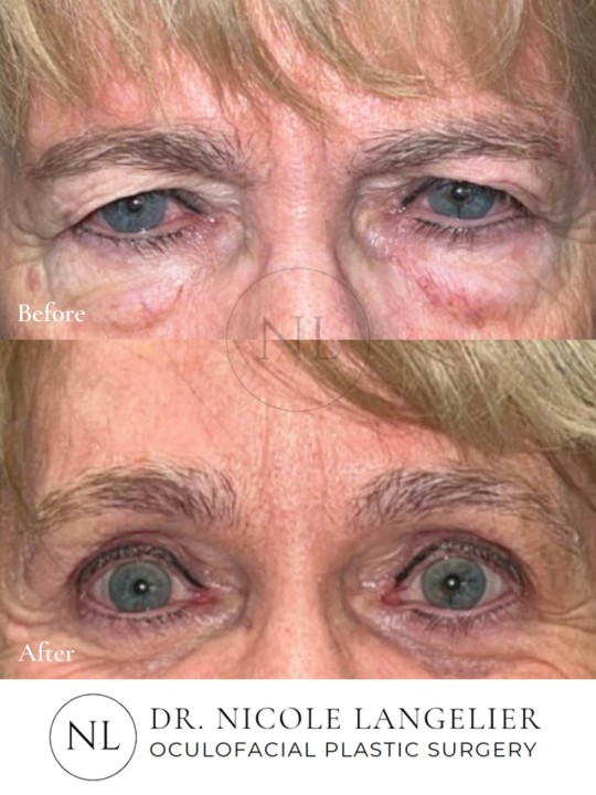 Before and After Brow Lift