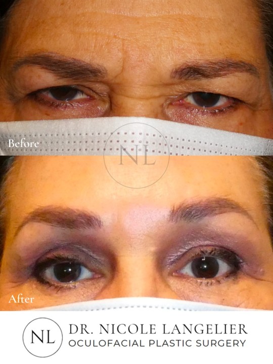 Before and After Brow Lift