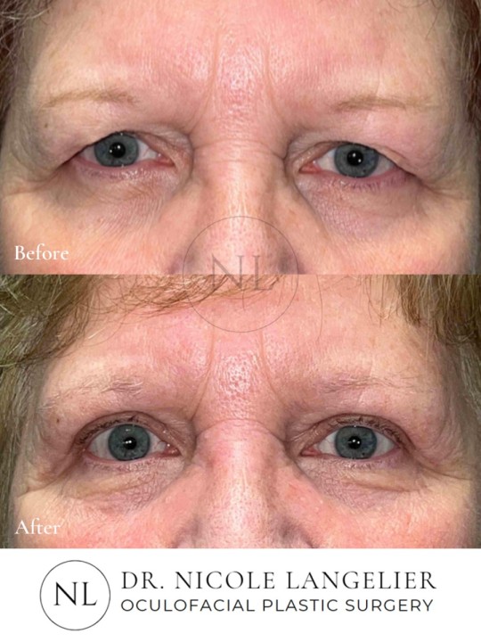 Before and After Brow Lift