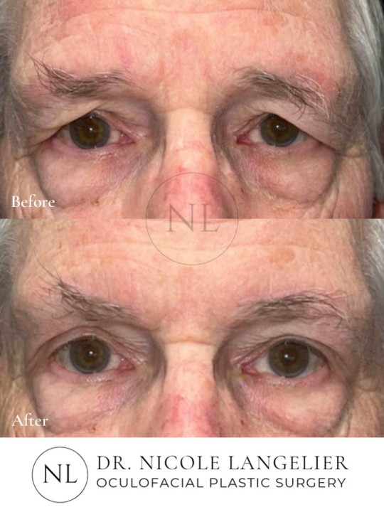 Before and After Brow Lift