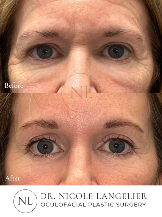 Before and After Brow Lift