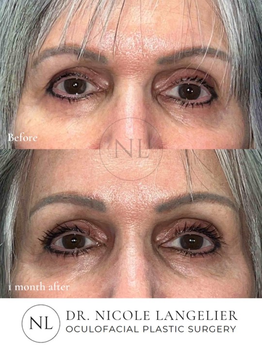 Before and 1 month After Brow Lift