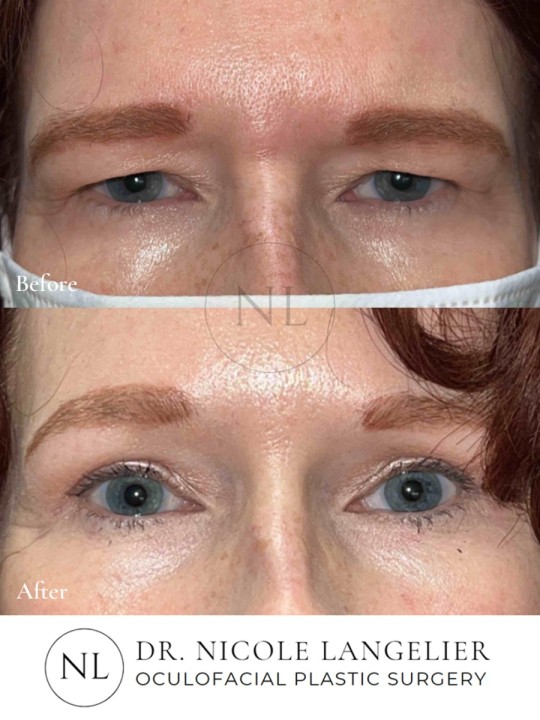 Before and After Brow Lift