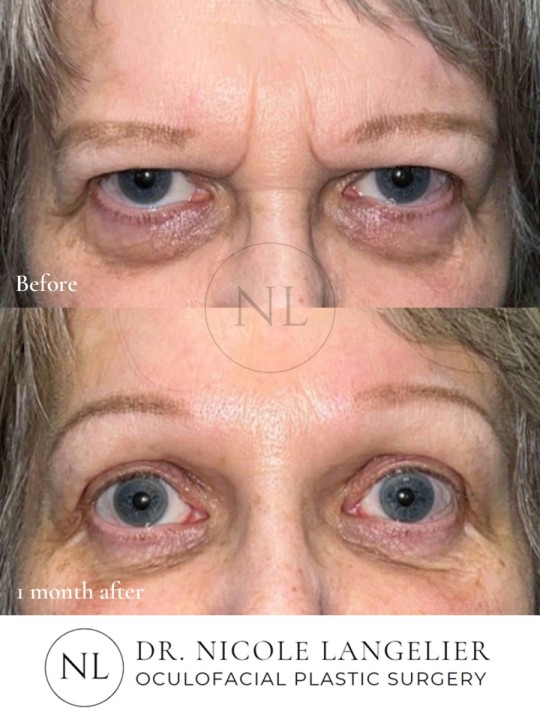 Before and 1 month After Brow Lift