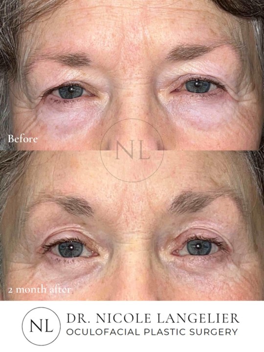 Before and 2 months After Brow Lift