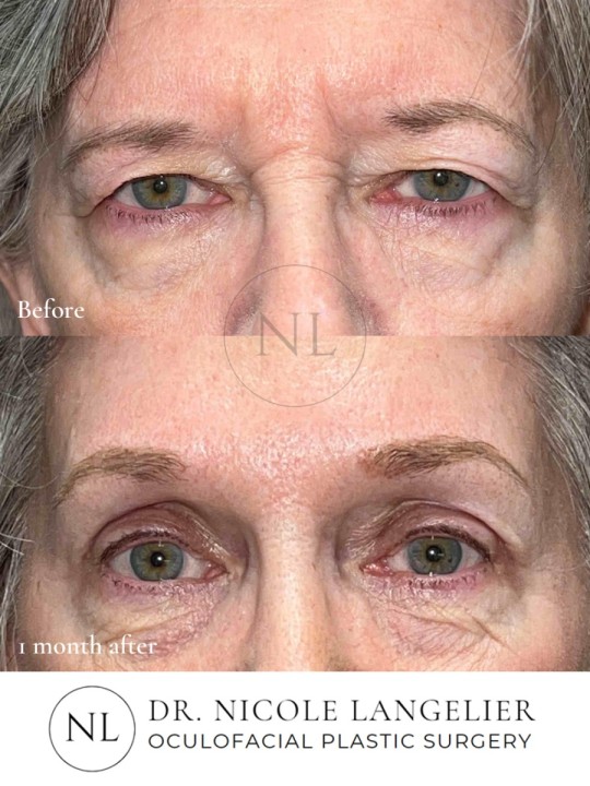 Before and 1 month After Brow Lift