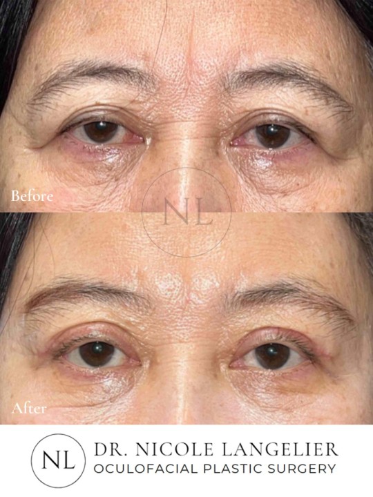 Before and After Brow Lift
