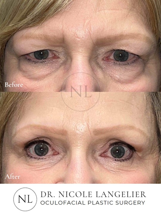 Before and After Brow Lift