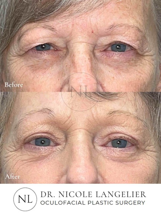 Before and After Brow Lift