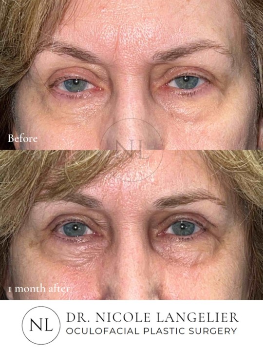Before and 1 month After Brow Lift