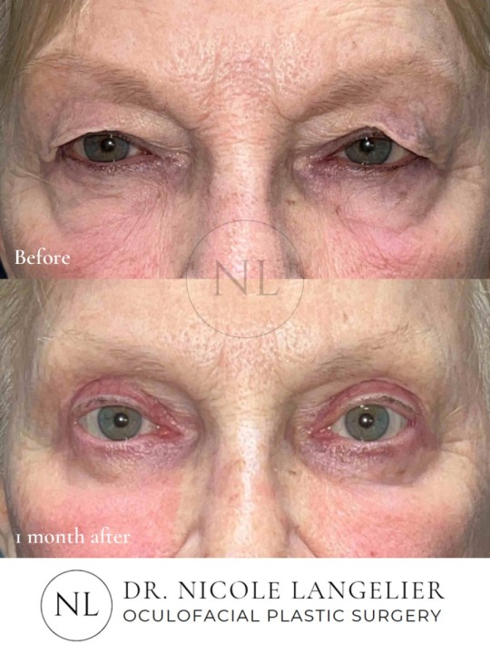 Before and 1 month After Brow Lift