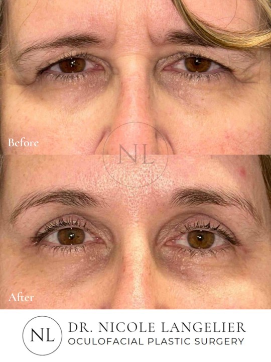 Before and After Brow Lift