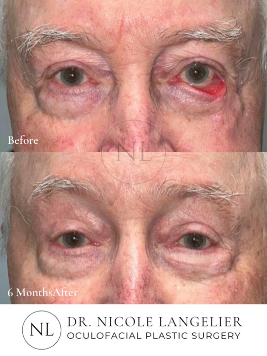 Skin Cancer Reconstruction