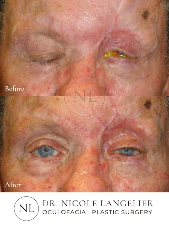 Skin Cancer Reconstruction