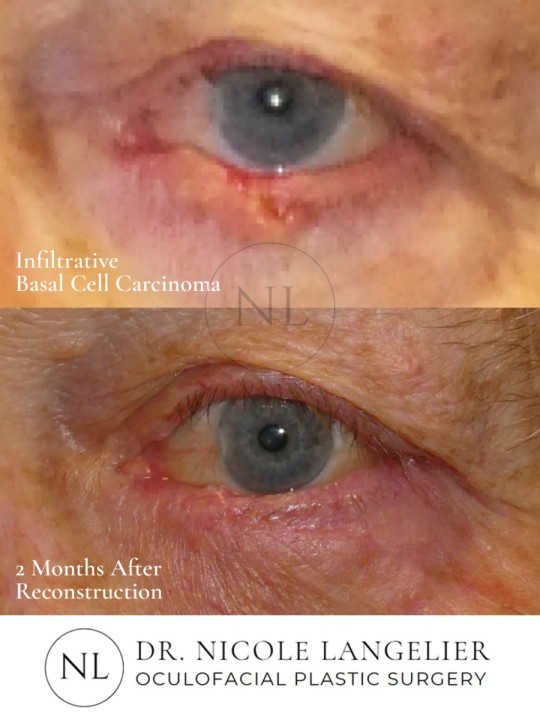 Skin Cancer Reconstruction