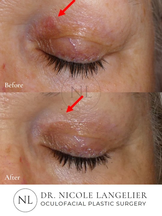 Skin Cancer Reconstruction