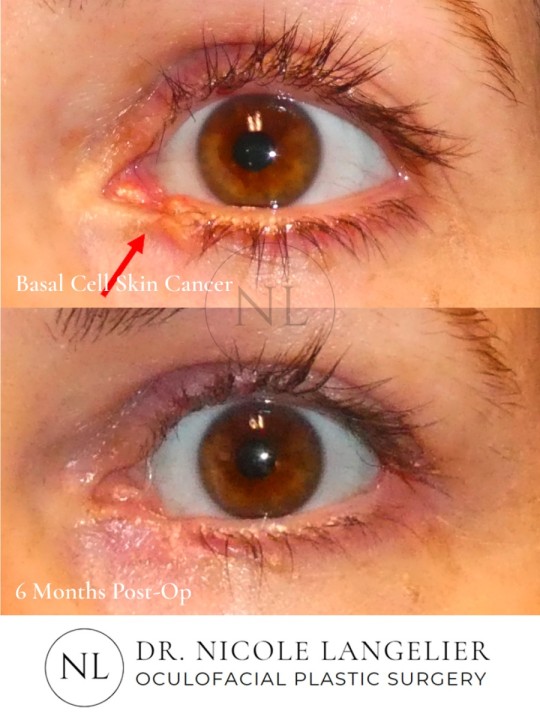 Skin Cancer Reconstruction