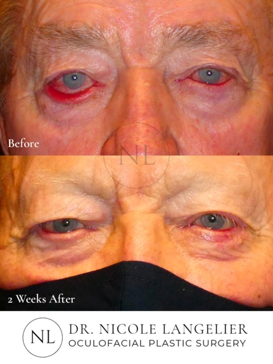 Left Lower Eyelid Skin Cancer Reconstruction
