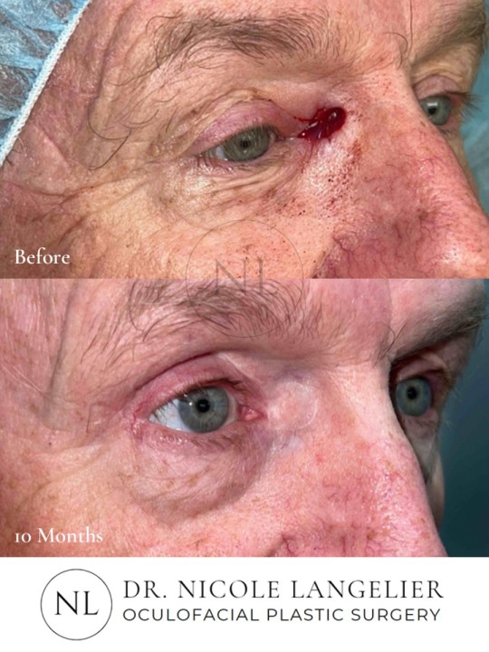Skin Cancer Reconstruction