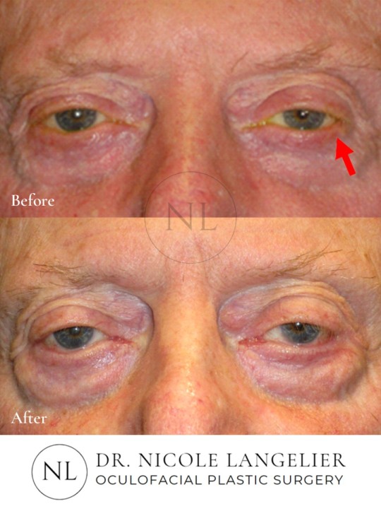 Skin Cancer Reconstruction