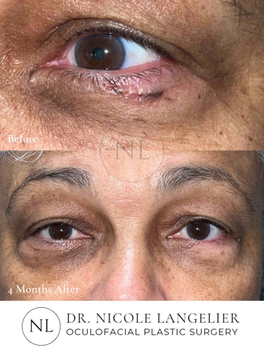 Skin Cancer Reconstruction