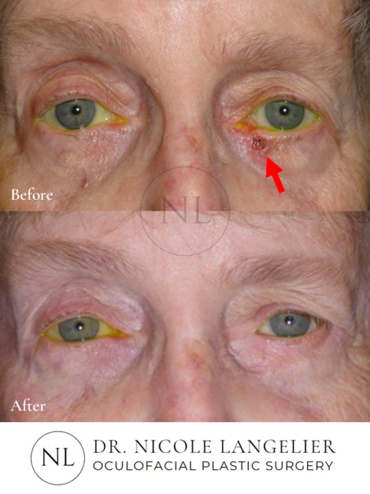 Skin Cancer Reconstruction