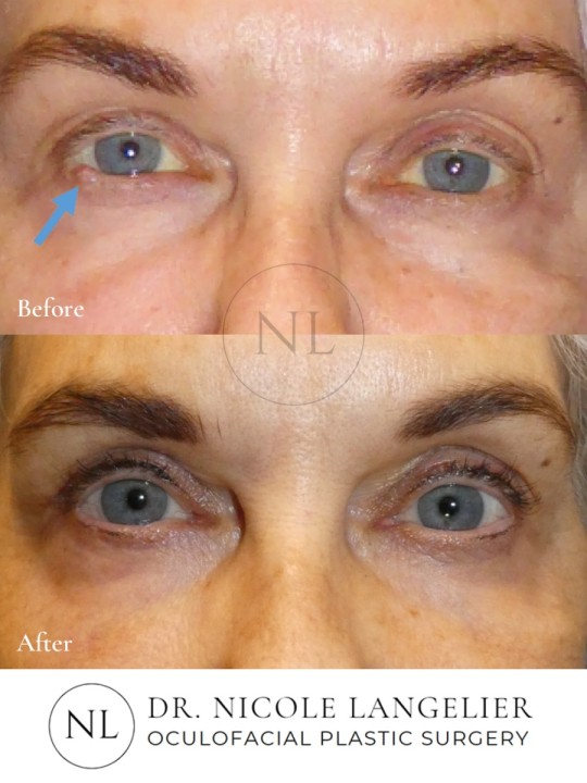Right Lower Eyelid Cancer Reconstruction