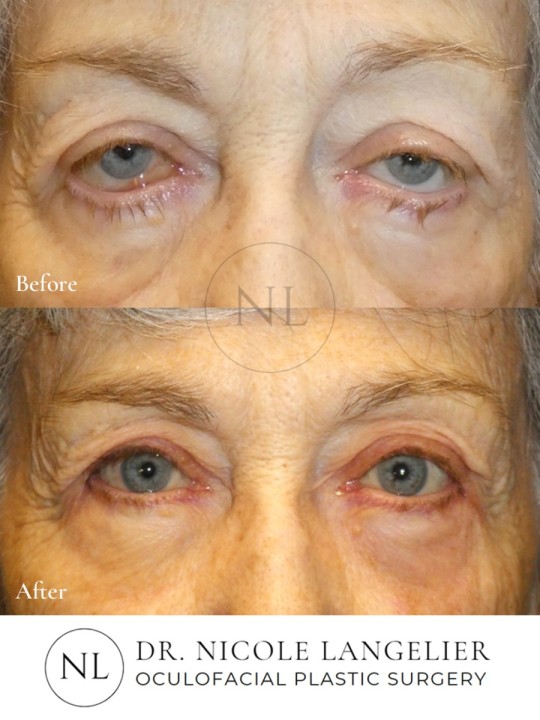 Lower Eyelid Ectropion Repair