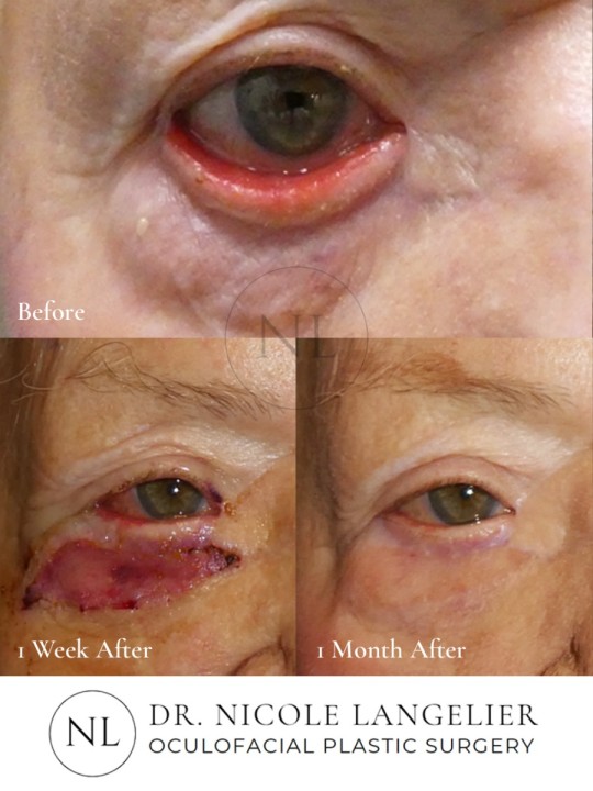 Lower Eyelid Ectropion Repair