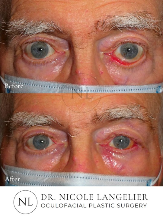 Bilateral Lower Eyelid Ectropion Repair