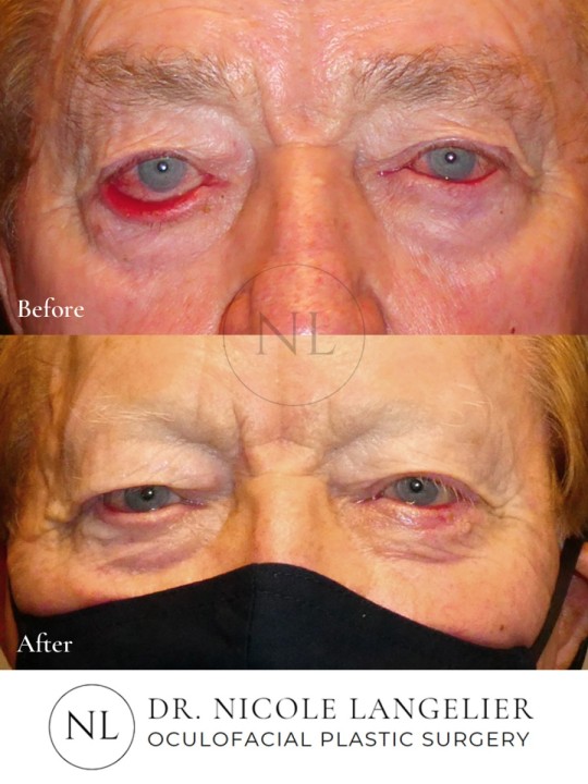 Bilateral Lower Eyelid Ectropion Repair