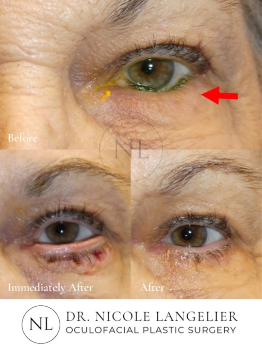 Lower Eyelid Entropion Repair with Quickert Sutures