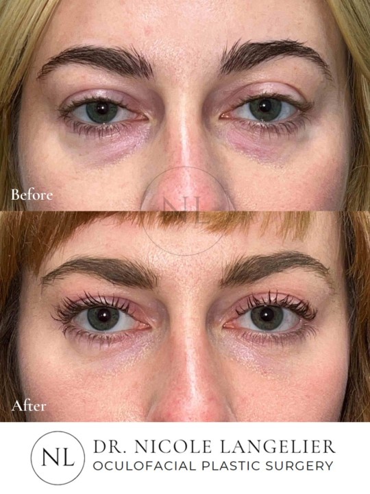 Lower Eyelid Blepharoplasty With Fat Transposition