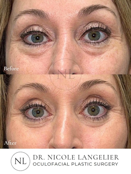 Lower Eyelid Blepharoplasty With Fat Transposition