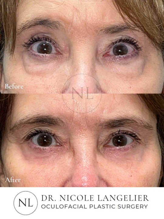 Lower Eyelid Blepharoplasty With Laser Resurfacing