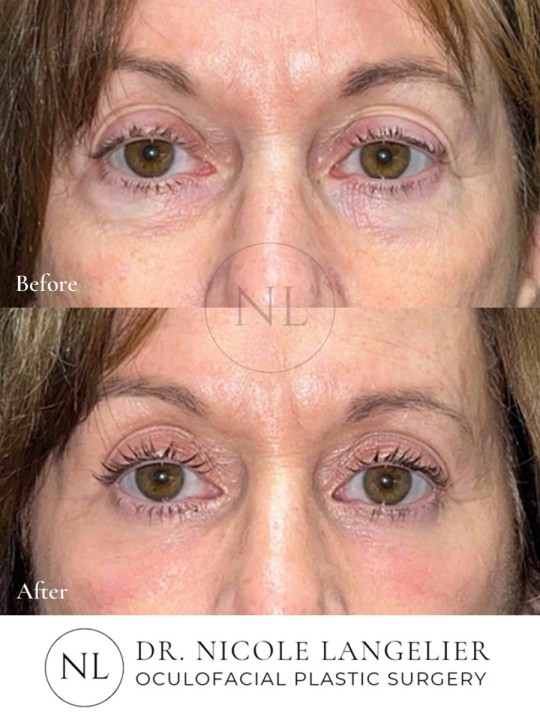 Lower Eyelid Blepharoplasty with Fat Transposition