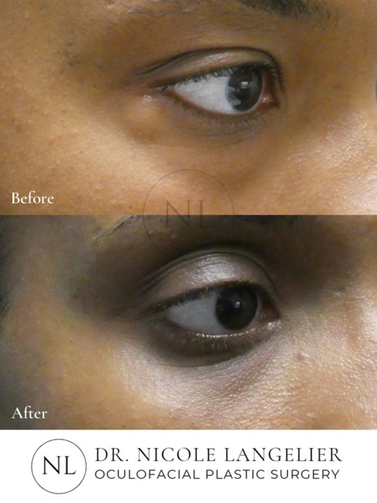 Female Lower Eyelid Blepharoplasty
