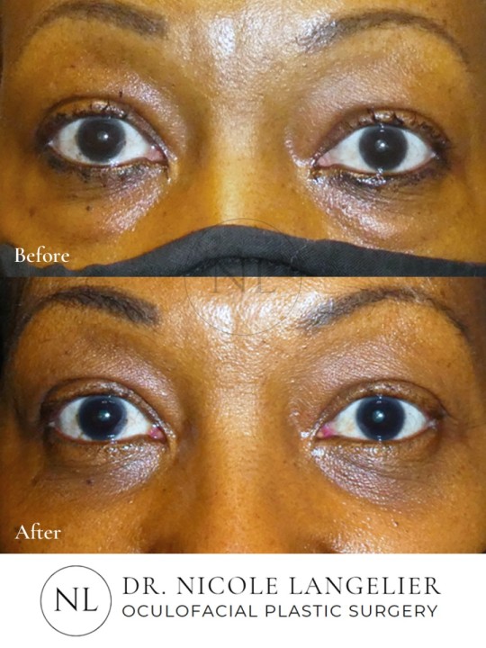 Female Lower Eyelid Blepharoplasty