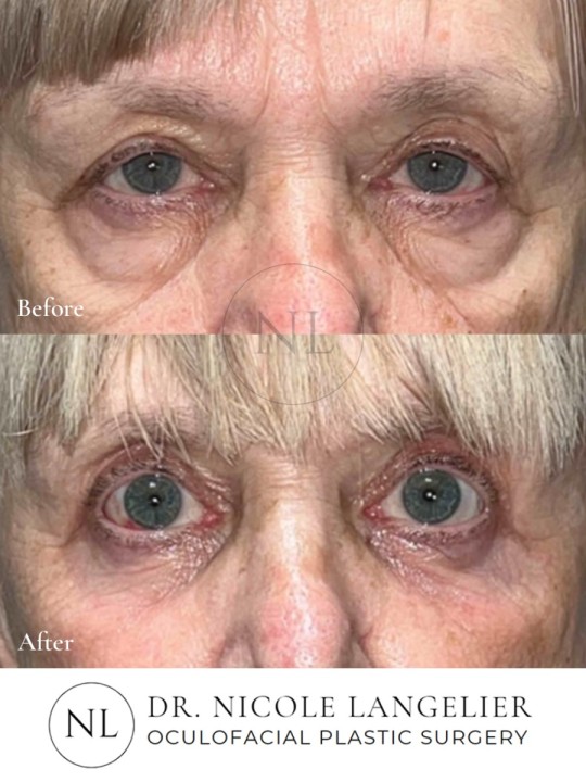 Female Lower Eyelid Blepharoplasty