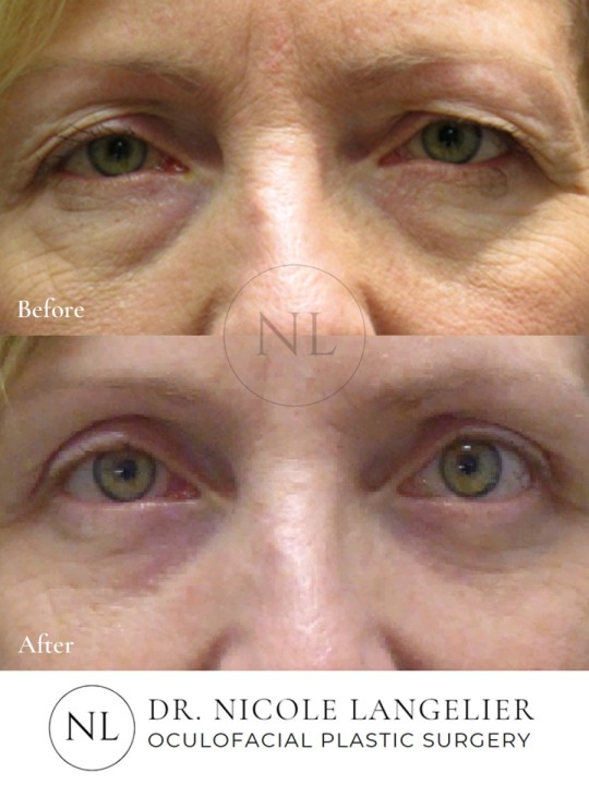 Female Lower Eyelid Blepharoplasty