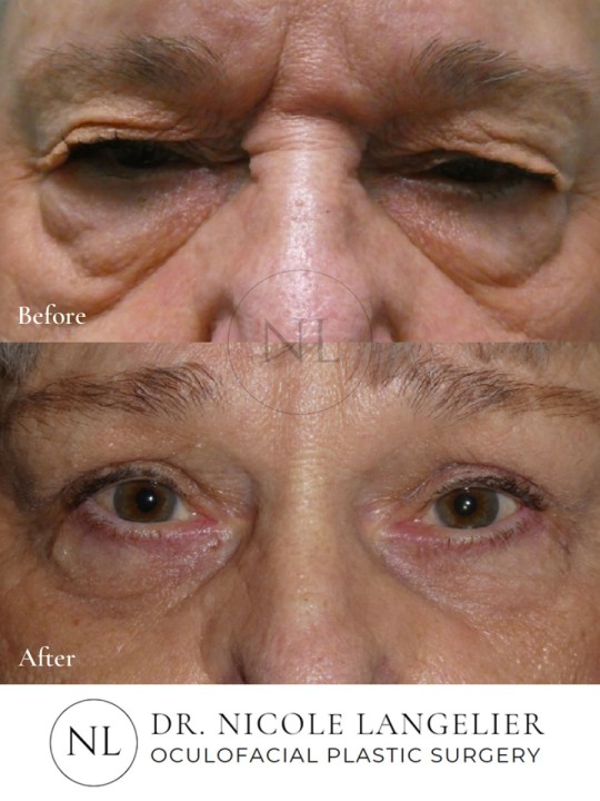 Female Lower Eyelid Blepharoplasty