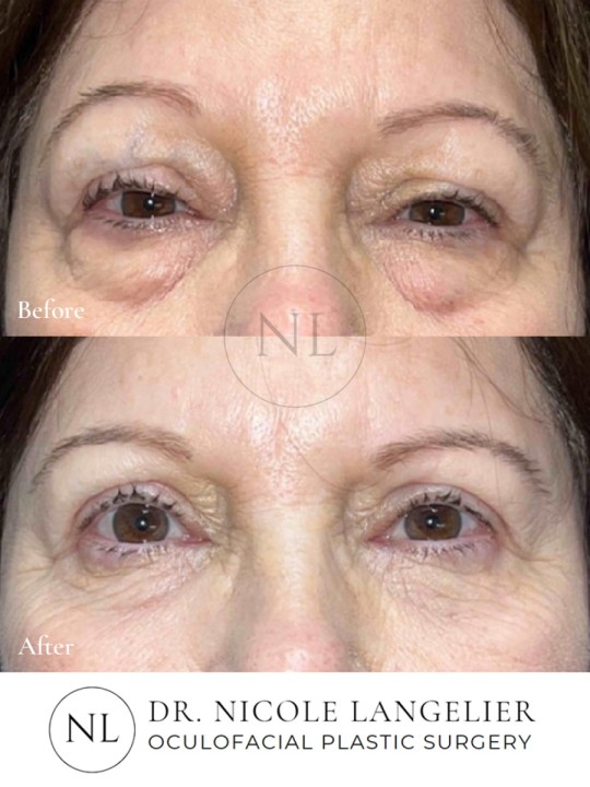 Female Lower Eyelid Blepharoplasty