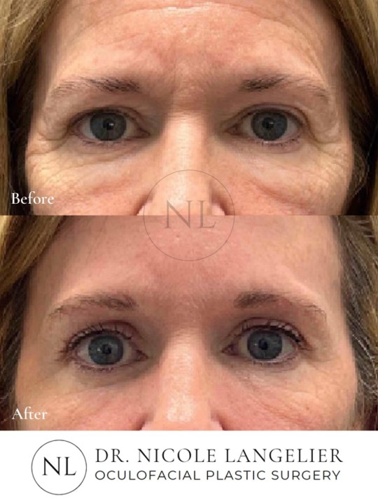 Female Lower Eyelid Blepharoplasty
