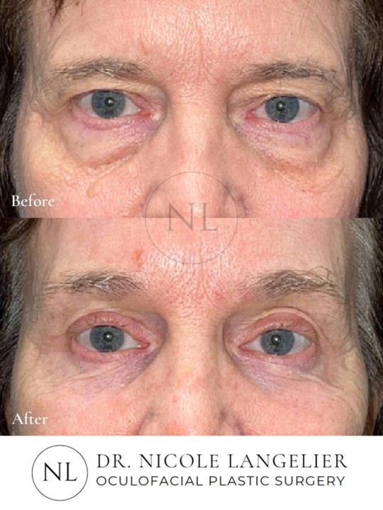 Female Lower Eyelid Blepharoplasty