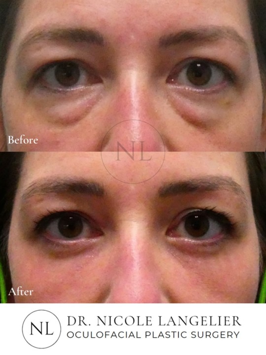 Lower Eyelid Blepharoplasty with Fat Transposition