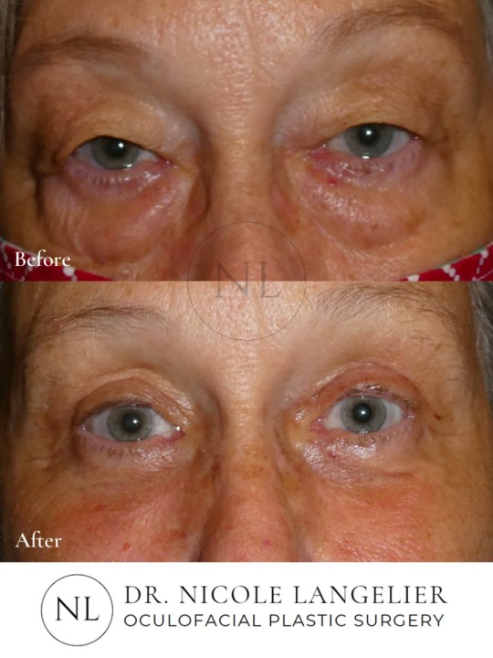Female Lower Eyelid Blepharoplasty